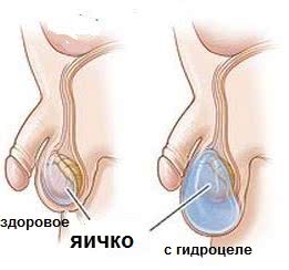 Лечение гидроцеле в Израиле