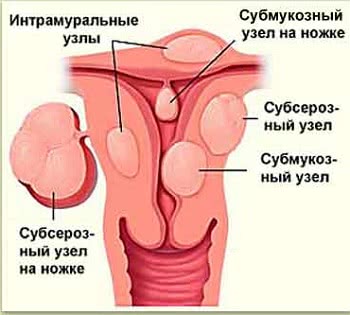 Лечение лейомиомы матки в Израиле