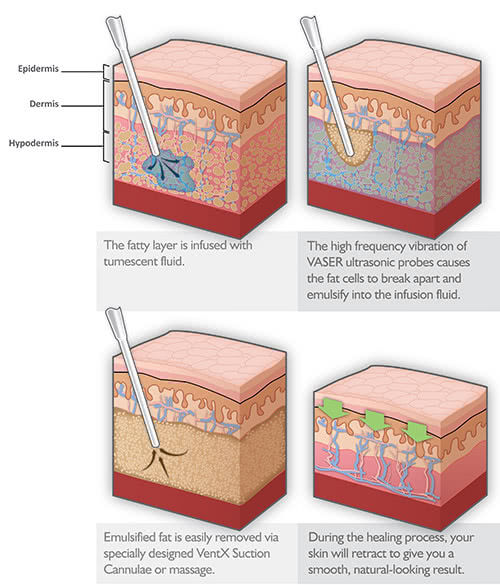 Liposuction in Israel with the help of Tumescent technology 