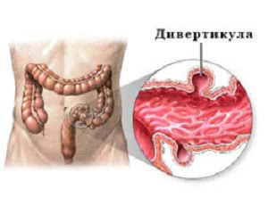 Лечение дивертикулита в Израиле